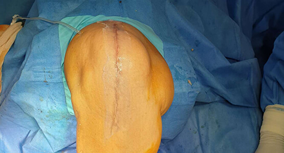 Joint Replacement Surgery Made Cosmetic
